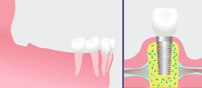 Dental Implants in East Ridge