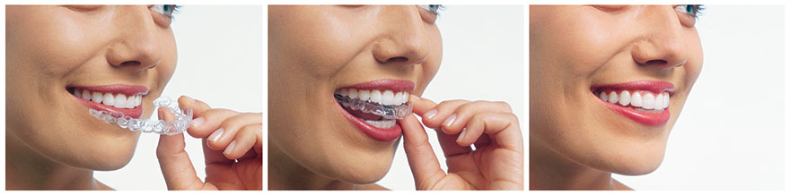Invisalign Aligner Therapy