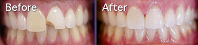 Porcelain Veneers