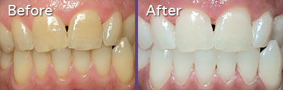 Professional Teeth Whitening